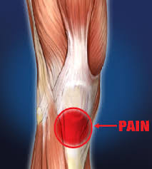 Patella tendon Pain – North City Physio